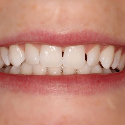 Composite Bonding - Smile 19 before